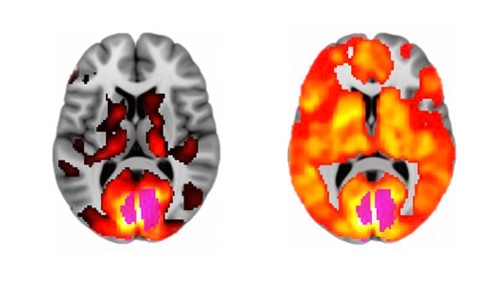 scan cérébral lsd